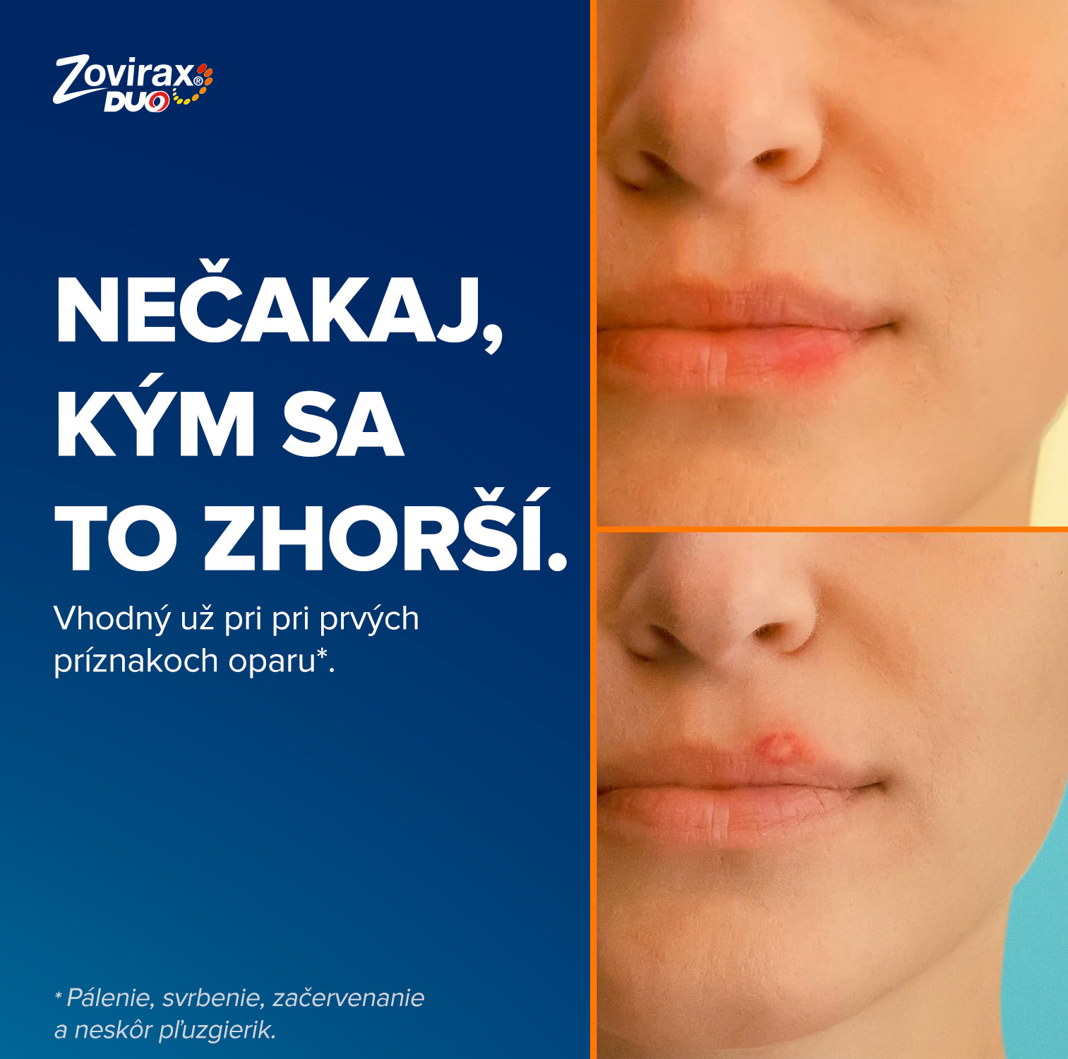 Zovirax DUO krém 2 g – Obrázok 3